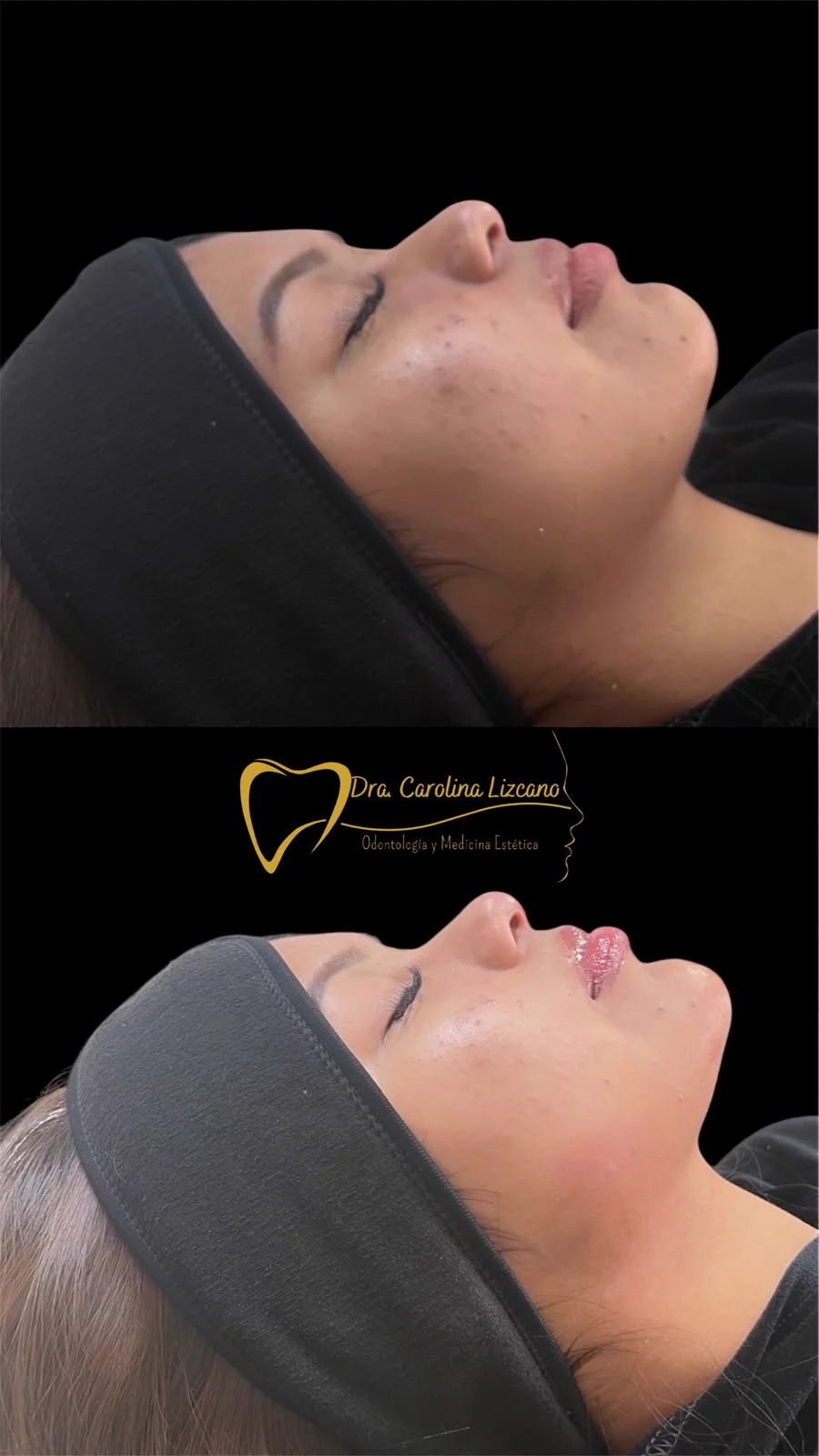 Antes y después de armonización facial con ácido hialurónico en Los Andes