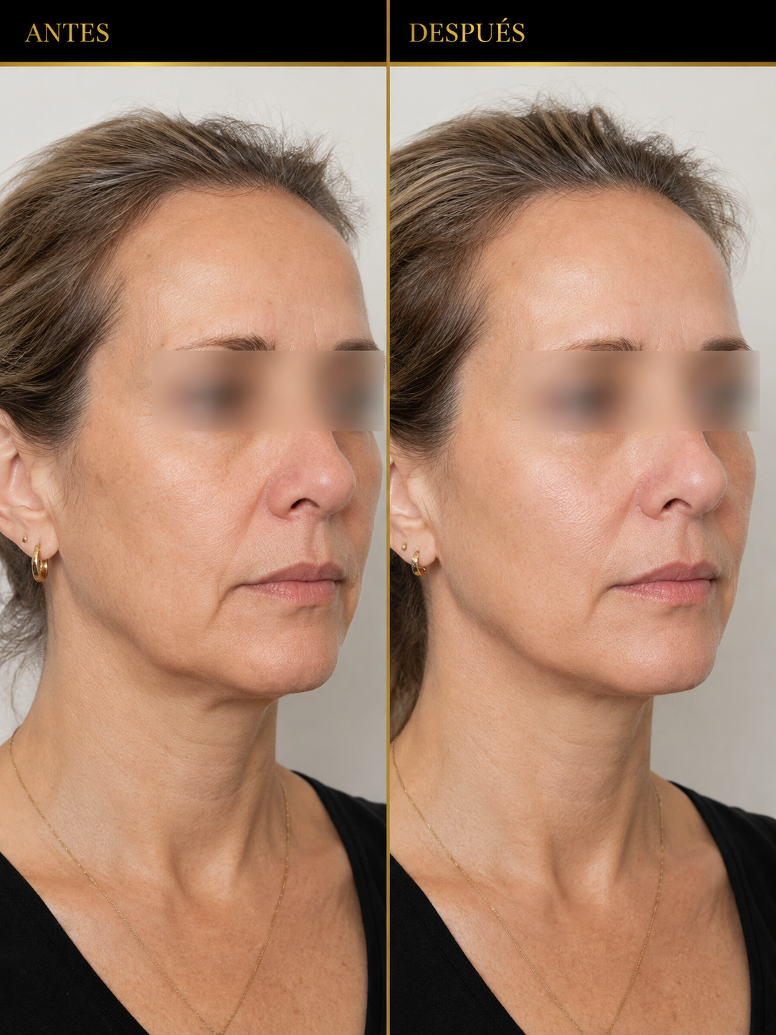 Bioestimuladores para firmeza de la piel, antes y después