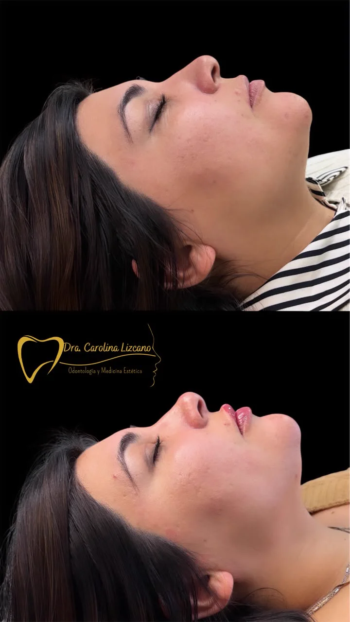 Antes y después de perfilado de labios con ácido hialurónico en Los Andes