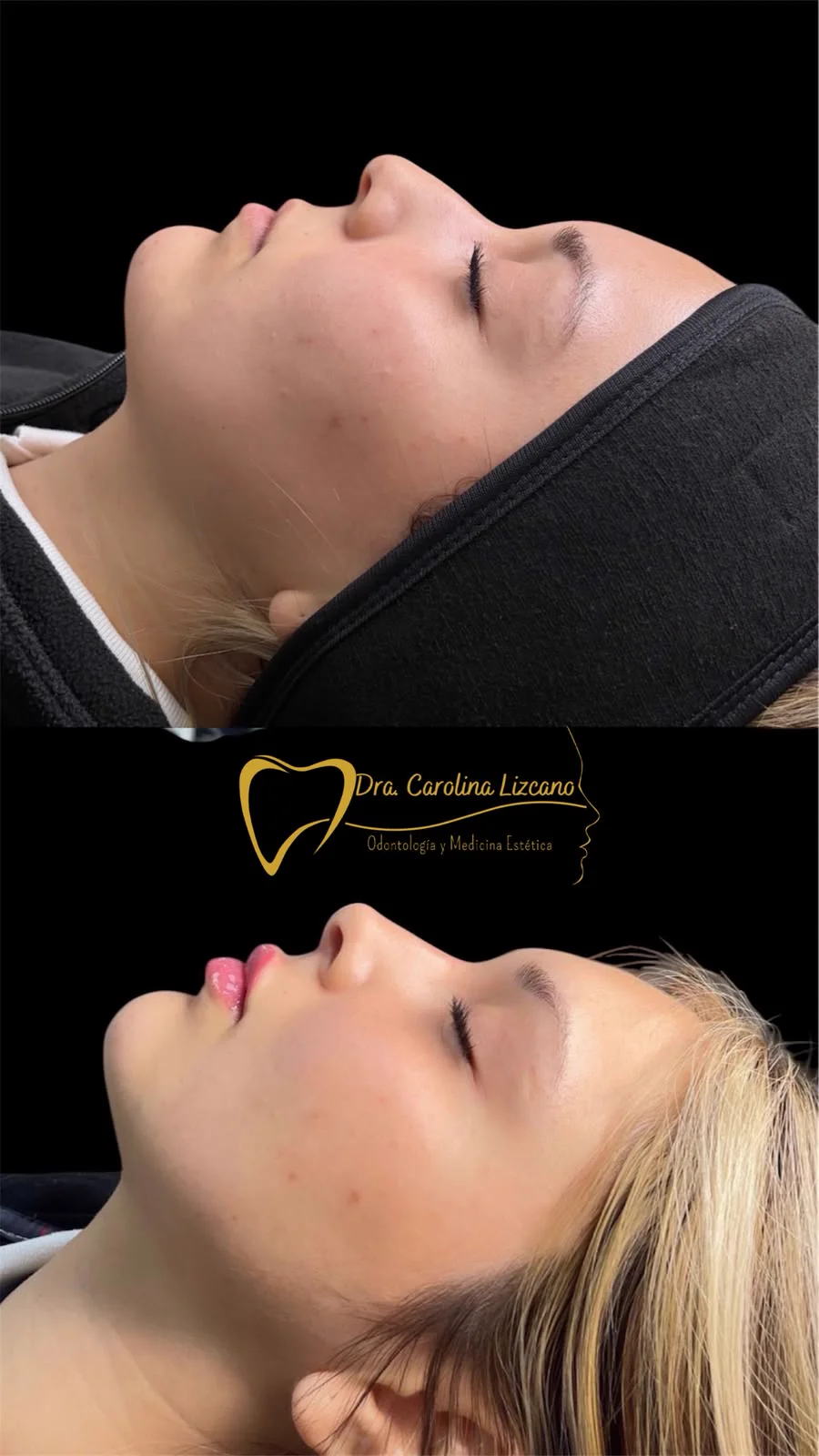 Antes y después de armonización facial con ácido hialurónico en Los Andes