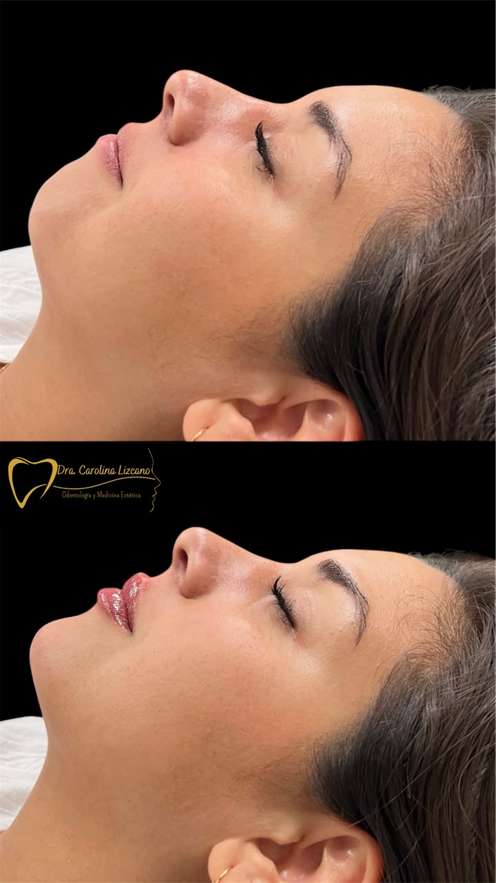 Resultado real de rejuvenecimiento facial, antes y después